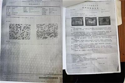 陈海林教授三焦气化法：开创乳腺癌治疗新路径